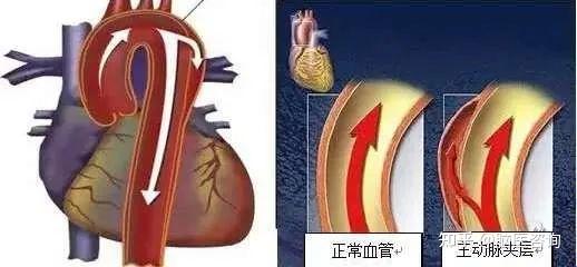 当心凶险的主动脉夹层