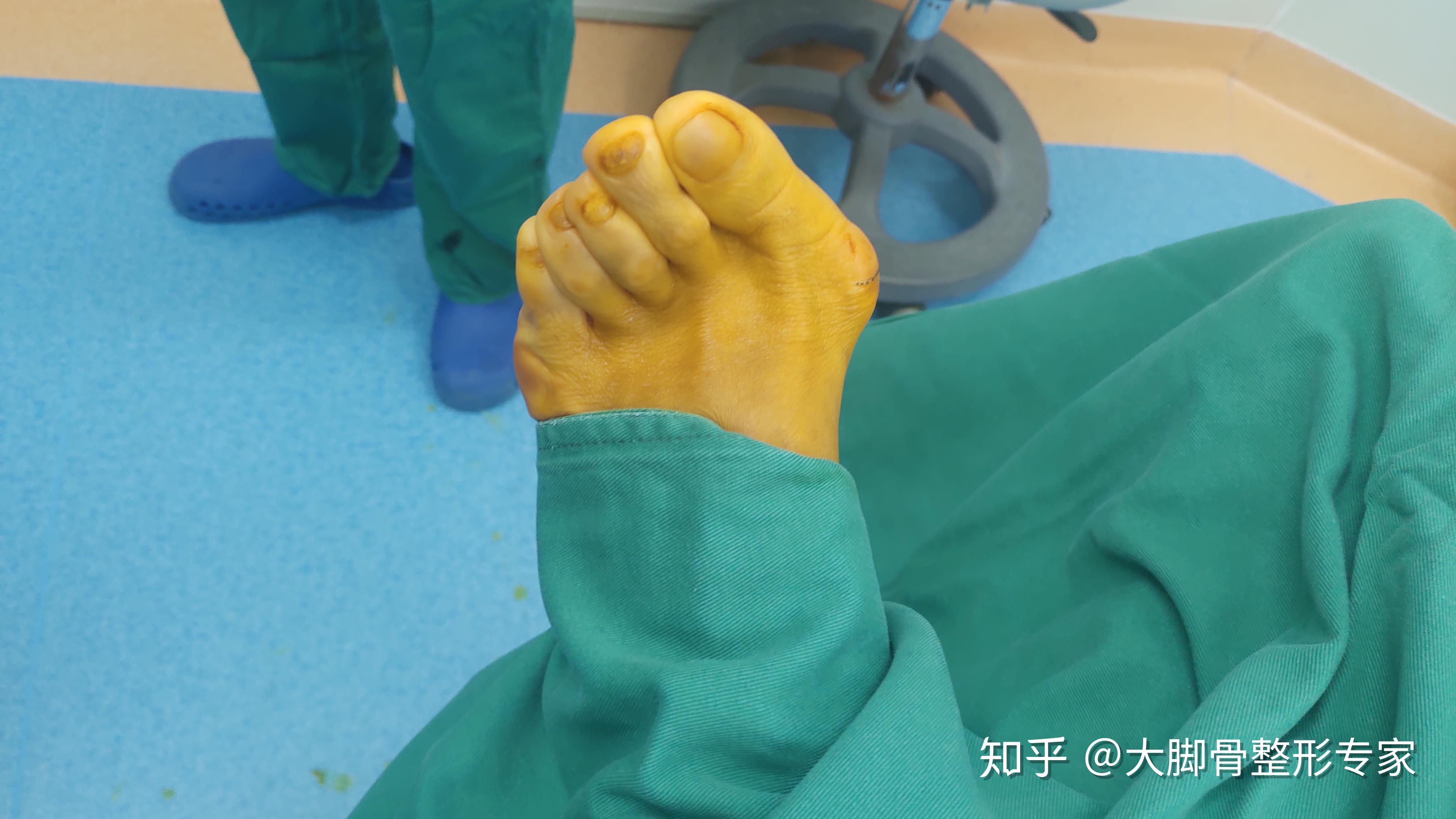 大脚骨手术 zhuanlan.zhihu.com