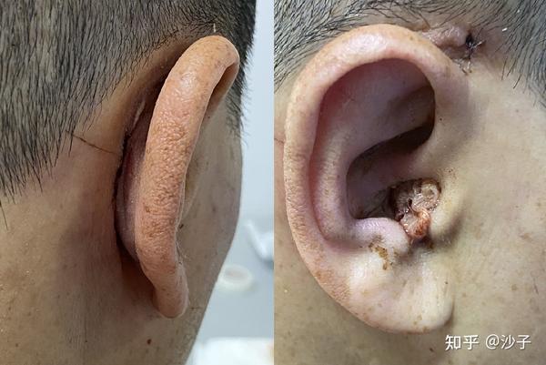 经验与教训:胆脂瘤中耳炎复发 重建听骨链