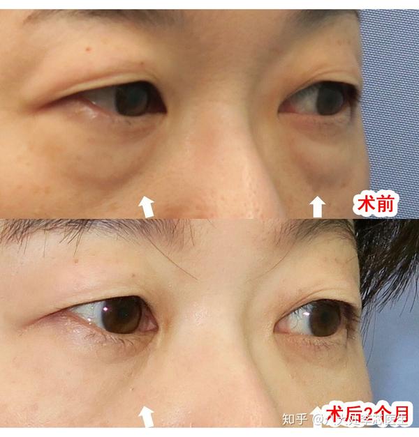 手术方案:外切祛眼袋 术后2个月效果