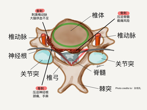 骨头上长了刺怎么破