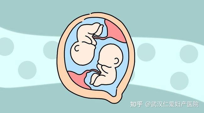 最终的分娩方式需要根据绒毛膜性,胎位,是否存在妊娠并发症与合并症