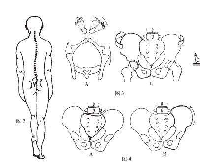 骨盆旋移征分型