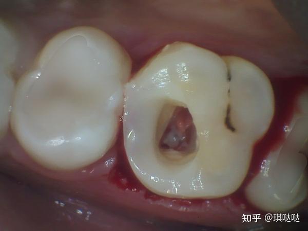 可以看到洞洞里的是牙龈和牙根,这颗牙有三个牙根,然后放上了杀神经的