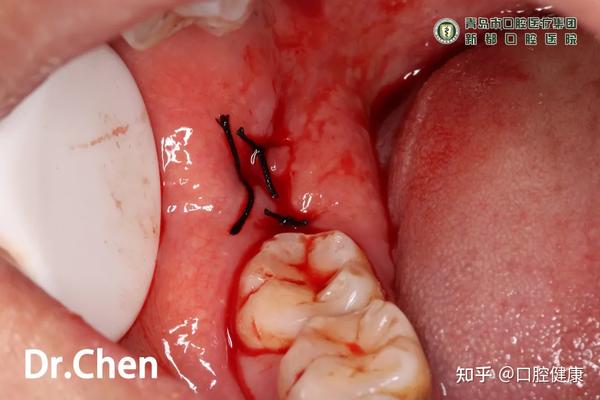 病例展示医用胶原蛋白减轻拔牙术后反应病例