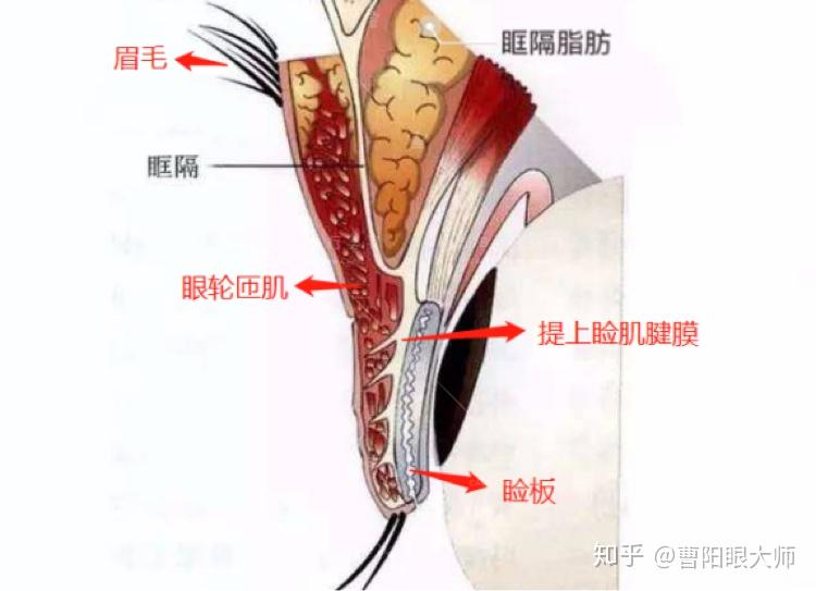 关于双眼皮成形的原理:先给大家看一看眼睛侧面双眼皮部分的结构图,再