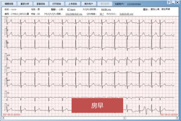 房早(房性早搏的简称)作为最常见的心律失常类型之一,我们在体检心电