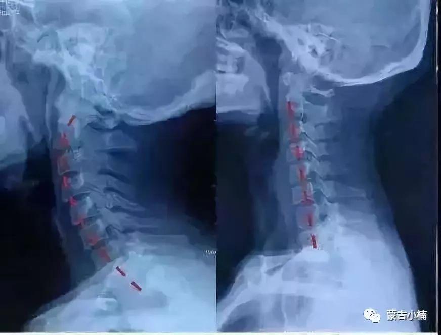 (左图:正常人x光片  右图:颈椎病患者