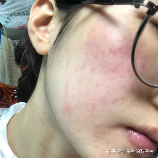 脸上长了很多又红又痒逆光疹子有些透明的尖头看起来油油的脂溢性皮炎