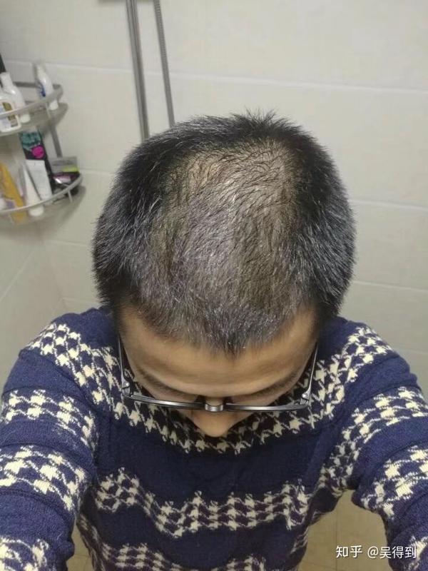 米诺地尔,看抗过敏米诺地尔防脱生发,脂溢性脱发 米诺地尔,保法止权威