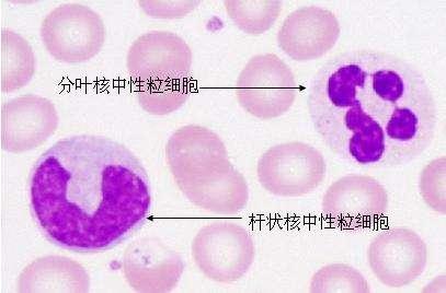 中性粒细胞 中性粒细胞在透明的外观以外,还有一个深紫红色的细胞核