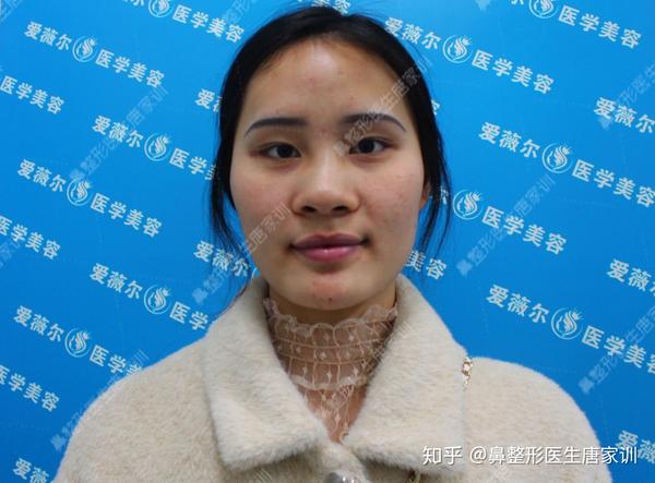 硅胶隆鼻 耳软骨垫鼻尖 鼻翼缩小 鼻小柱延长术前术后对比