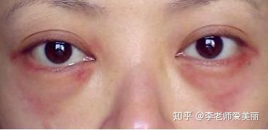 科普一下外切去眼袋第二天用不用换药做完眼袋手术注意什么
