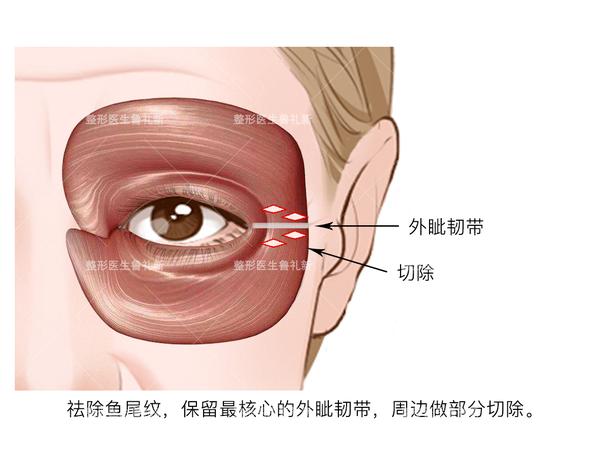 我采用的方式是保留住最核心的那根"外眦韧带",精细切除外侧轮匝肌