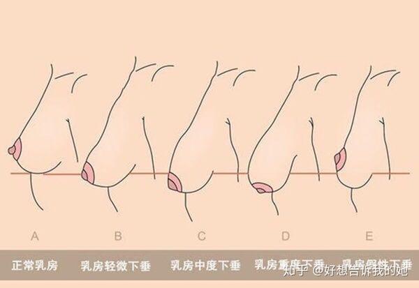 隆胸方式/乳房矫正全介绍(下)|胸型发育不正,乳房下垂