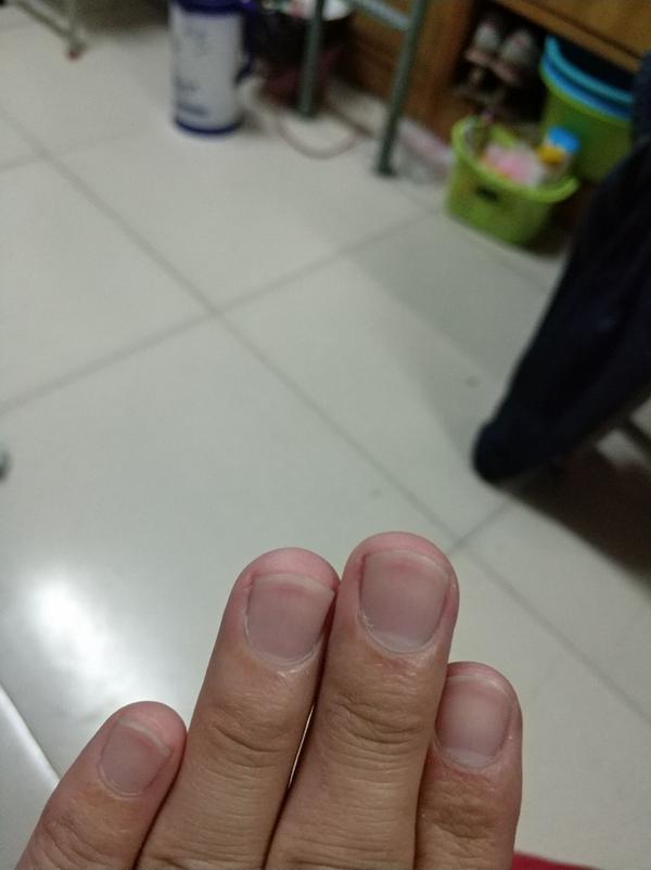 手上总是长肉刺怎么办?