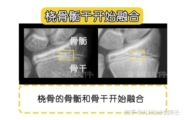 生长减速期:桡骨骺干开始融合 或 籽骨发育成熟