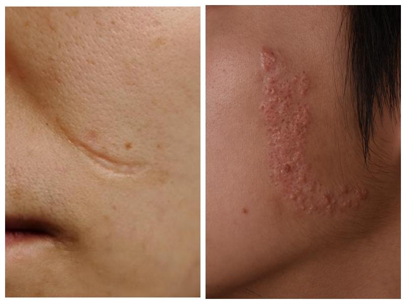 皮肤受到创伤,为何会出现凹凸两种不同类型的疤痕?