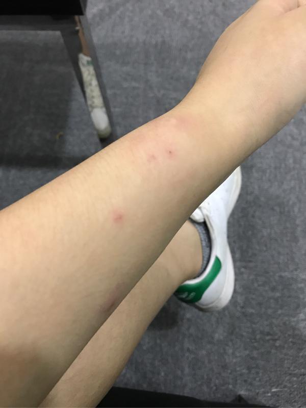 被猫咬出血了怎么办?