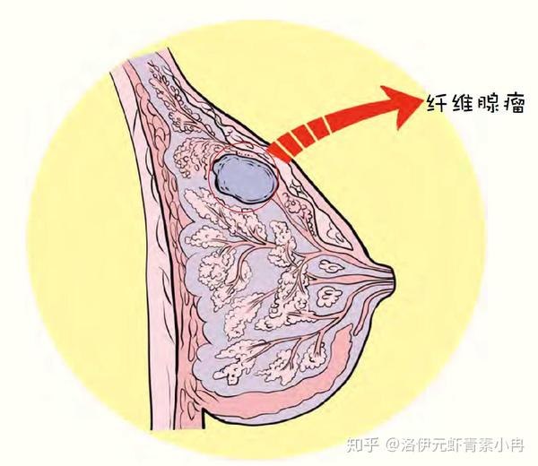 会导致乳腺正常组织被破坏,创伤大,疤痕,没有切除干净,二次手术,三次