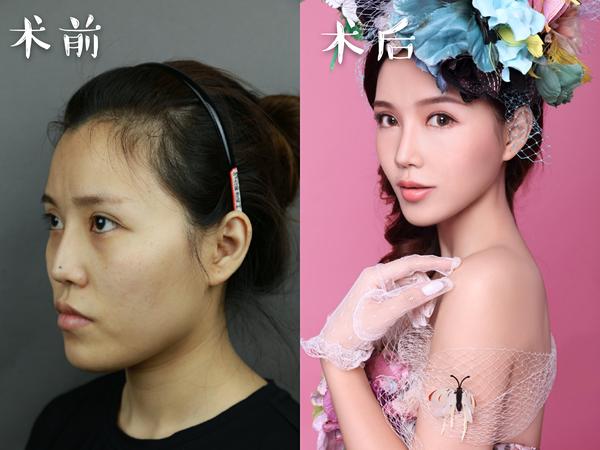 多年来秉持着整形外科医生改变轮廓人生的使命感,固执地选中凸嘴,双