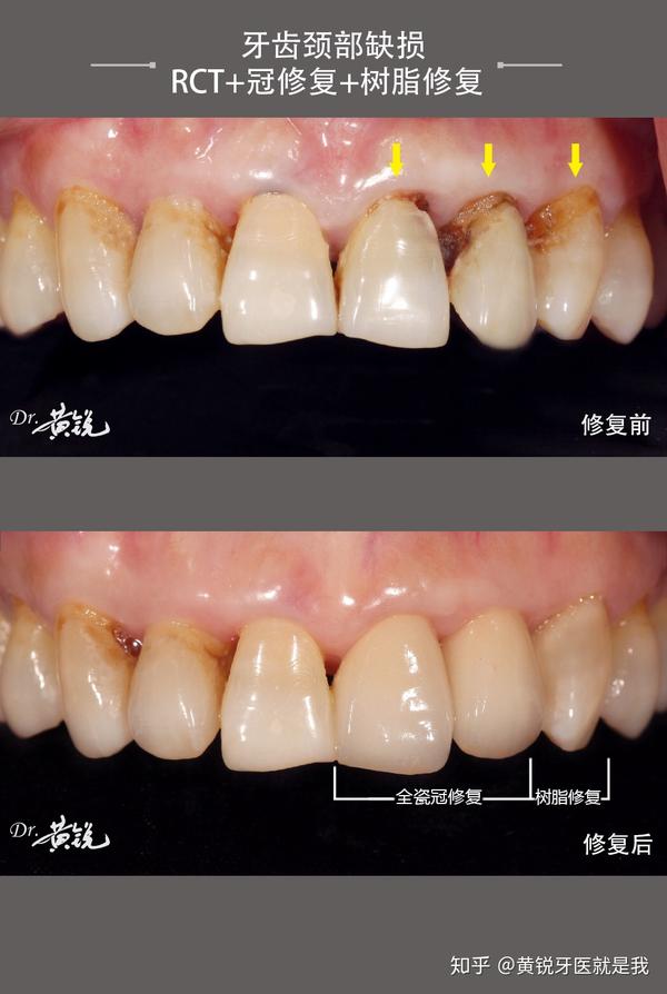 [牙齿颈部缺损/rct 冠修复 树脂修复〕        患者前牙多颗颈部龋坏