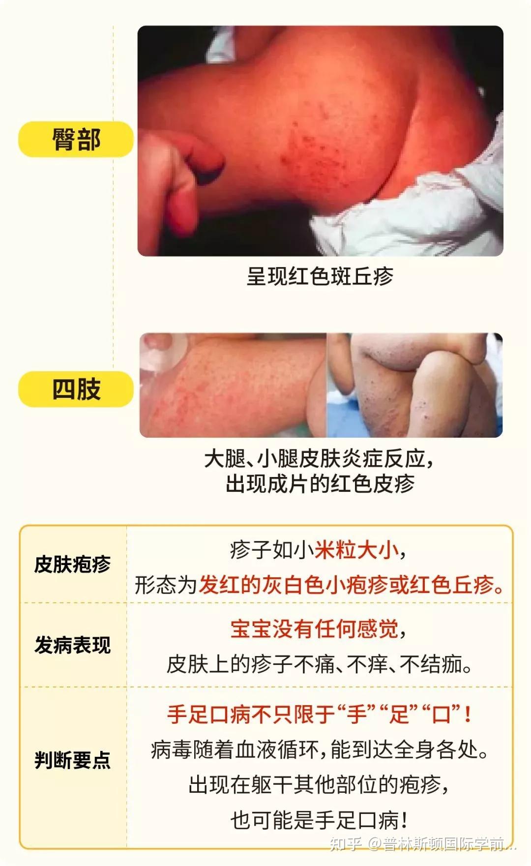 注意了手足口病来势汹汹专找这些场所兴风作浪