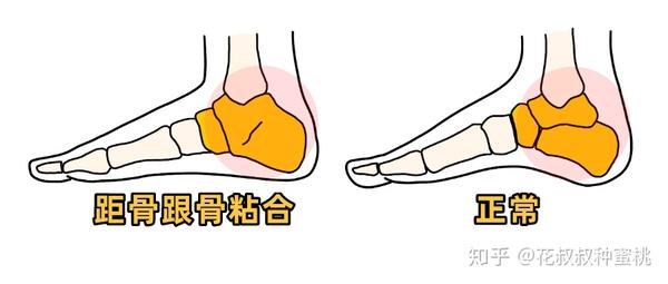 足弓与体态102——扁平足,如何矫正?