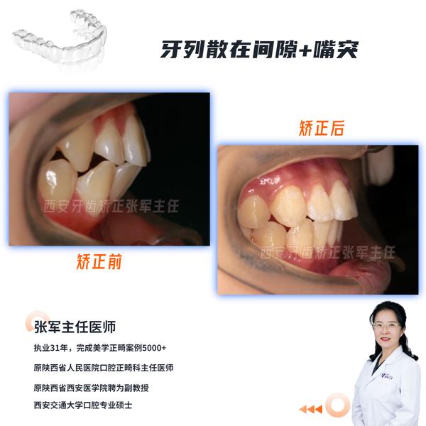 西安牙齿矫正唇倾正畸对牙根是否有影响