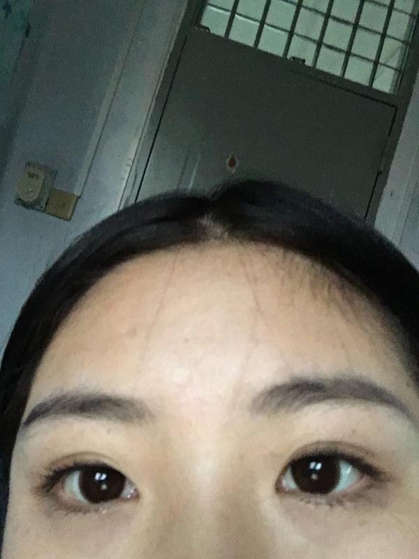 长期双眼皮贴会导致眼皮松弛吗?