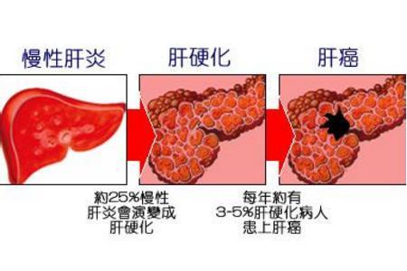 远离肝癌乙肝患者要想远离肝癌4件事必须做到位