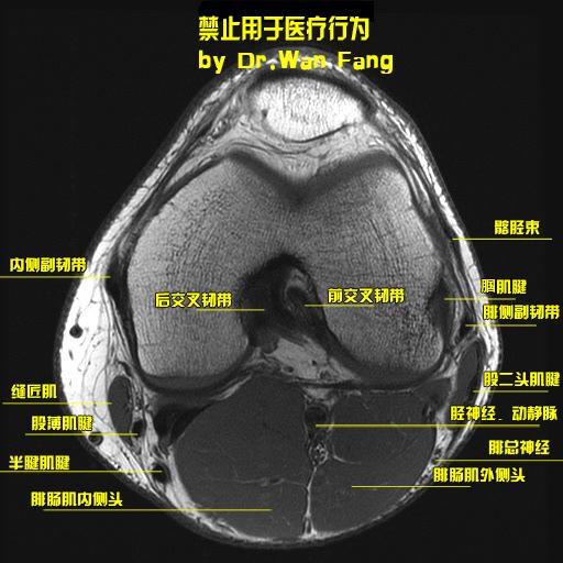 自制史上最详细膝关节磁共振应用解剖图谱(轴位 冠状位 矢状位)
