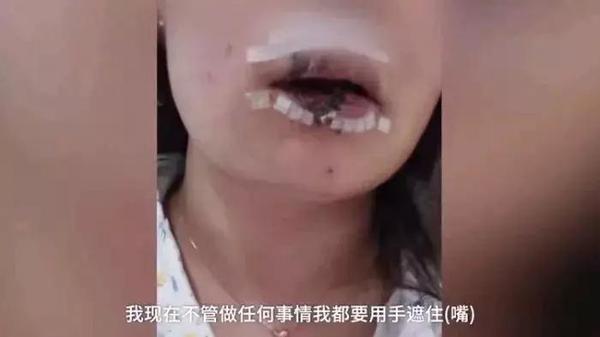 女子喂朋友养的阿拉斯加吃葡萄下嘴唇竟然当场被咬掉一半