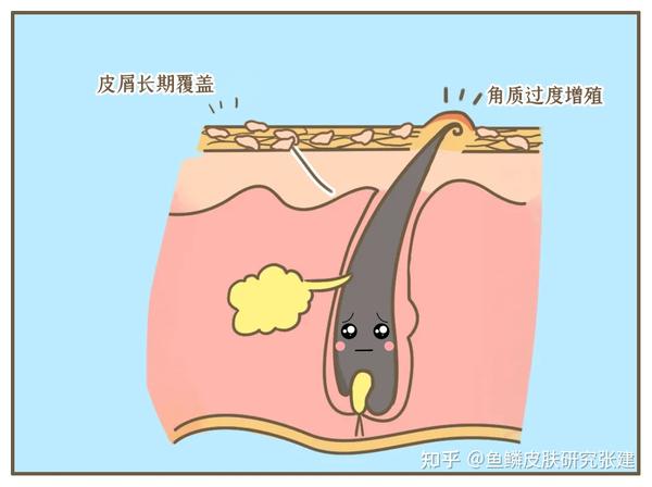 毛囊口堵塞,形成角质栓