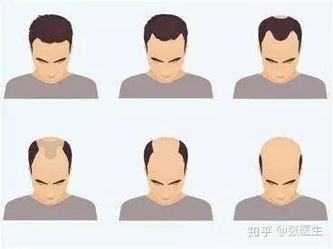遗传性脱发传男不传女