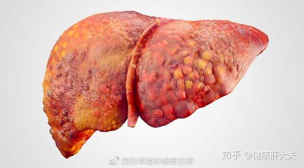 患了肝硬化就只有等死