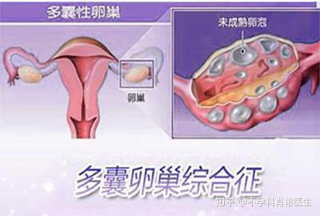 多囊卵巢综合征患者的促排卵治疗