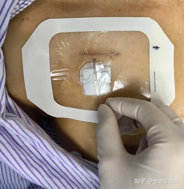 输液港扎针最全示范再也不怕病人说技术不到位了