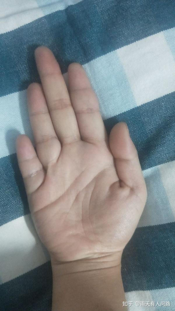 我的小拇指特别短特别奇怪究竟是为什么?