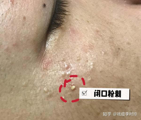 顽固的闭口终于清理出了堵塞物(黑头和油脂粒,粉刺栓)