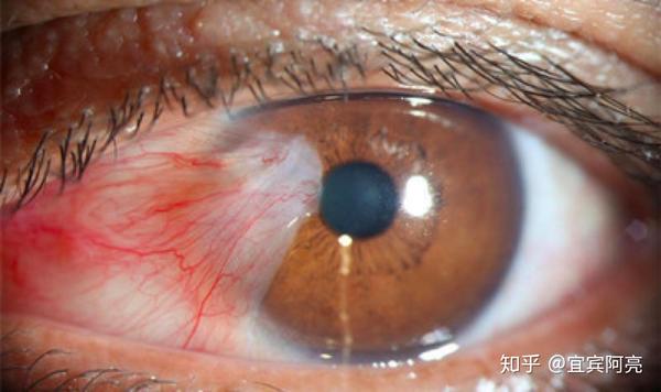重点应该检查有无充血,是否光滑,有无睑裂斑,翼状胬肉,滤泡,乳头