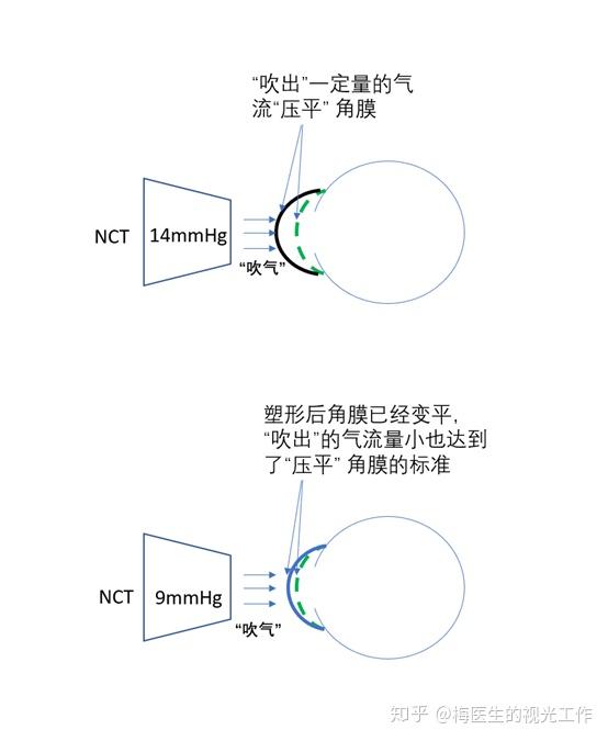 6mm直径圆形平面时,经角膜射入的光线经反射进入观测器.