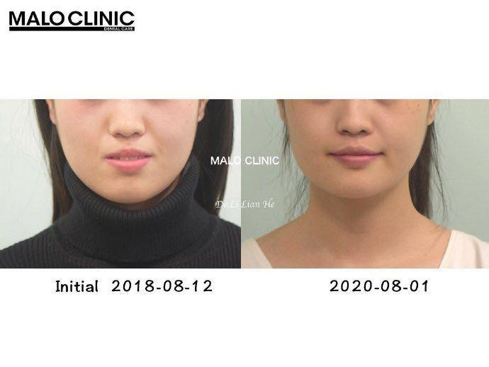 北京牙齿矫正丨骨壁薄患者易发生骨开窗,做好规避风险