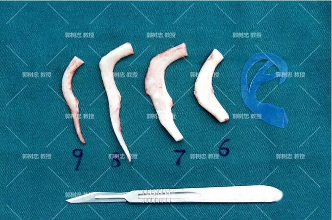 耳再造那些事儿十四切取肋软骨为什么有差异