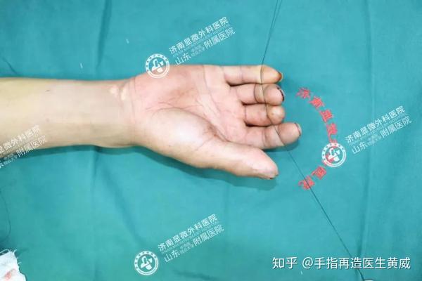 见证奇迹 | 多例手指再造手术全部成活!