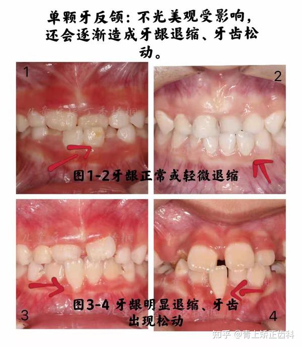 下图都是5-8岁的孩子单颗牙反颌,反颌的时间越久,造成牙龈退缩