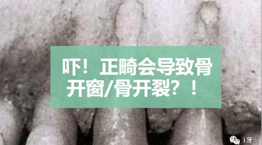 吓!正畸会导致骨开窗/骨开裂?