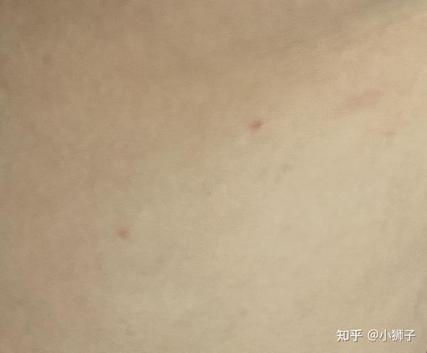 到底是跳蚤还是螨虫叮咬
