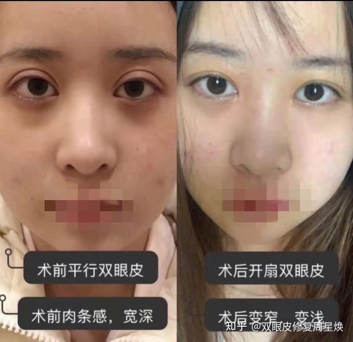 如何改善眼窝凹陷改善眼窝凹陷的方法,可以选择玻尿酸和自体脂肪填充