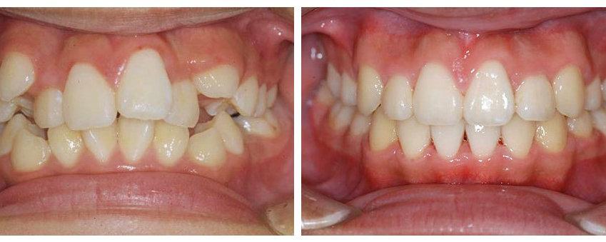 牙齿矫正案例之牙齿紊乱